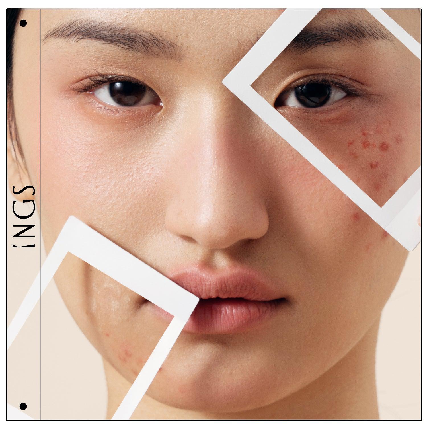 DEWY SKIN ESSENCE Brightening Repairing Facial Best Serum for Acne